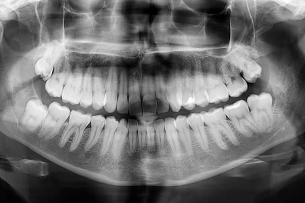 Dental radiography (ortopanoramica). Digital X-ray teeth scan.